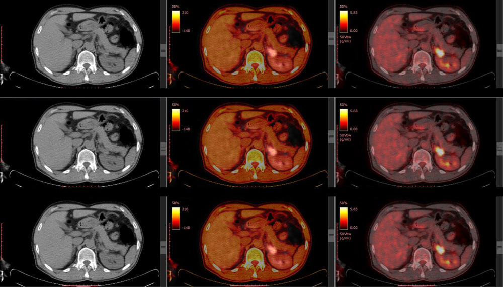Positron Emission Tomography - PET/CT Scan