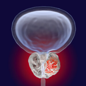 3D illustration showing presence of tumor inside prostate gland which compresses urethra