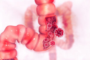 cancer cells attacking colon