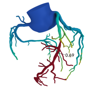 Heart Flow Analysis in Dallas TX