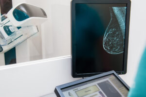 mammogram of a breast.